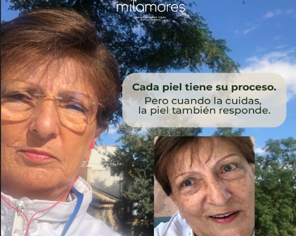 ¿Manchas en la piel? Descubre cómo Lucía logró desvanecer las manchas de su piel con MagicOil ✨