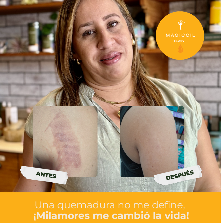 De una quemadura de segundo grado a una piel radiante: El testimonio de Irauli