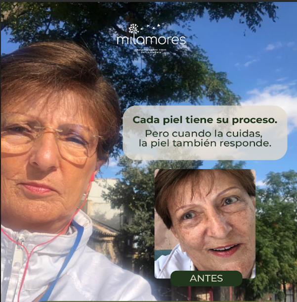 ¿Manchas en la piel? Descubre cómo Lucía logró desvanecer las manchas de su piel con MagicOil ✨